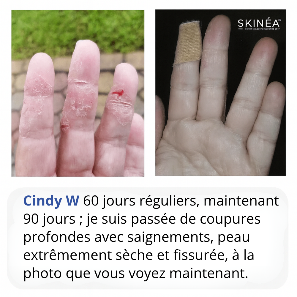 Skinéa - Probiotique Peau